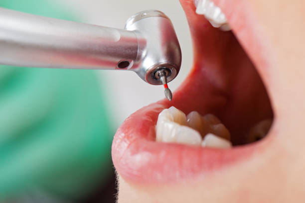 Best Emergency Dental Extractions in Grayvle, IL